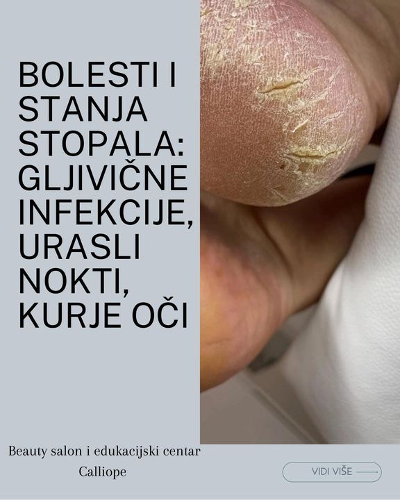 Bolesti i stanja stopala: gljivične infekcije, urasli nokti, kurje oči